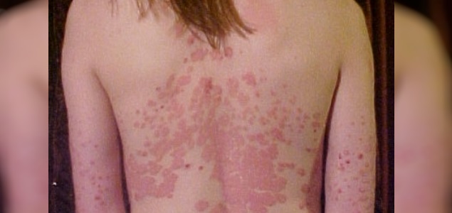Los tratamientos eficaces de la psoriasis