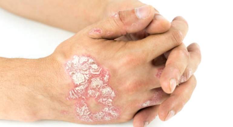 manos-psoriasis-istock-770.jpg