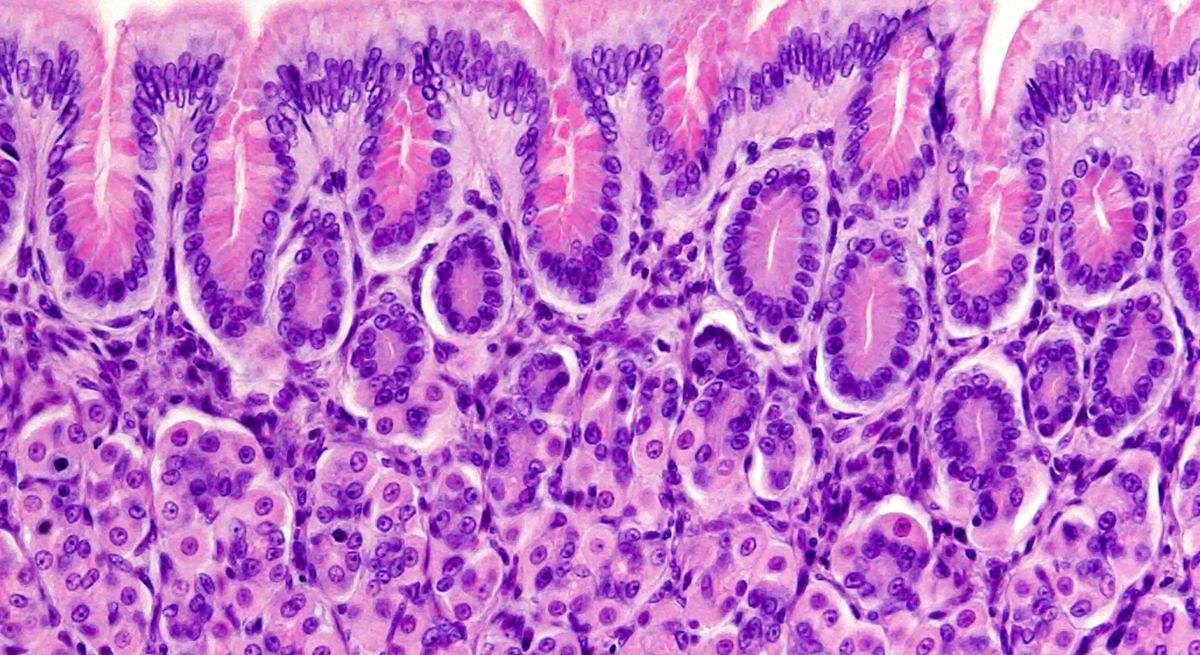 Debilitar la mucosa gástrica