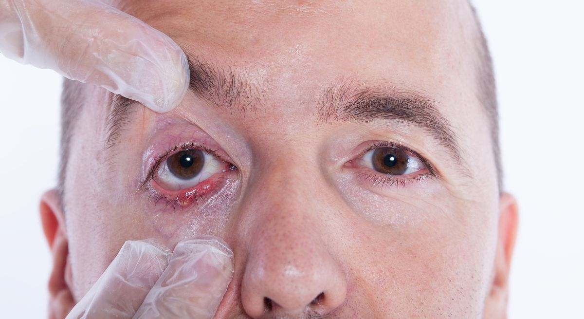 Ni frotar con un anillo de oro ni con una llave hueca: esta es la forma correcta de eliminar este problema de los ojos