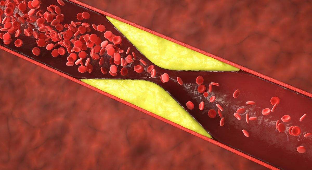 El tratamiento que promete erradicar el colesterol malo: revolucionará la cardiología