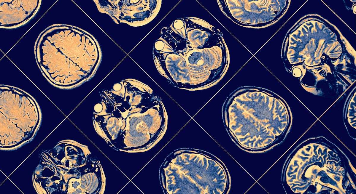 Científicos detectan el arma secreta contra el cáncer cerebral más común y agresivo en adultos: mejora el diagnóstico y es útil para el futuro