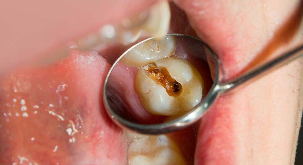 Previenen las caries