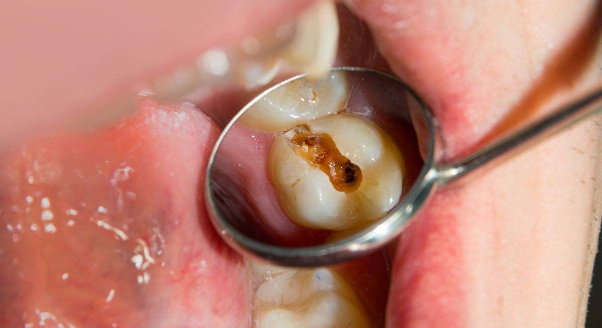 Previenen las caries