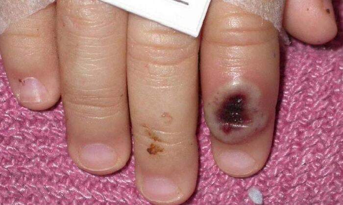 viruela-mono-monkeypox-efe-cdc.jpg