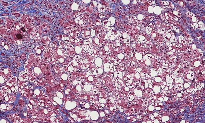 hepatittis.jpg