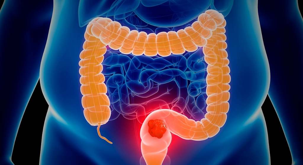 Riesgo de cáncer de colon