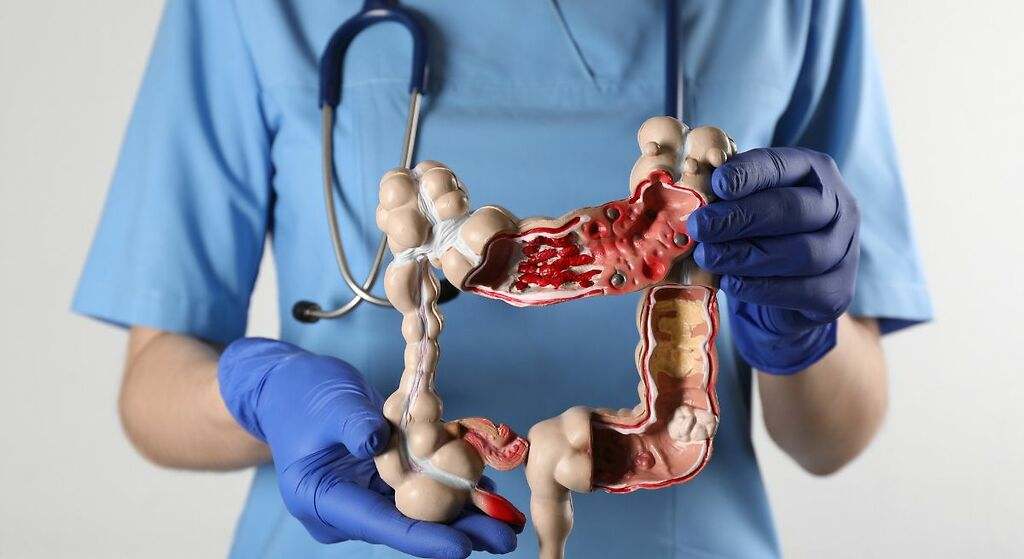 Cáncer de colon
