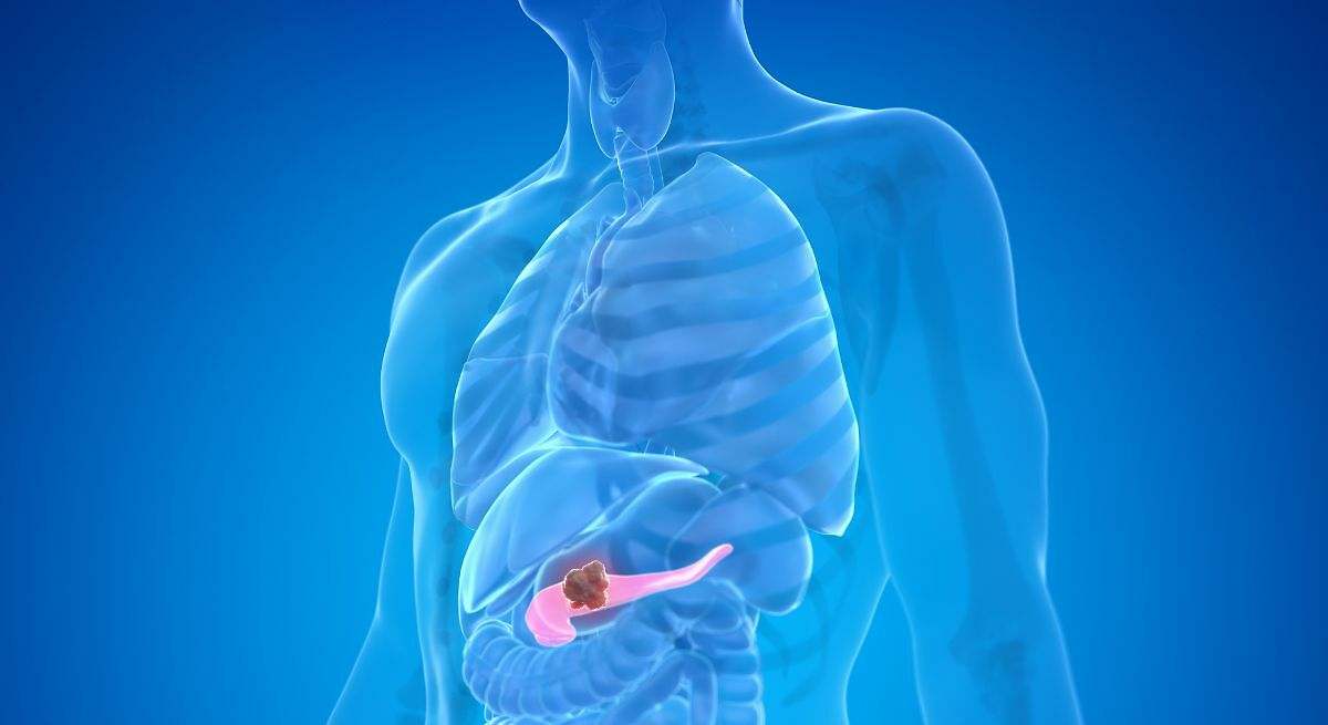 Cáncer de páncreas: causas, síntomas y cómo prevenirlo