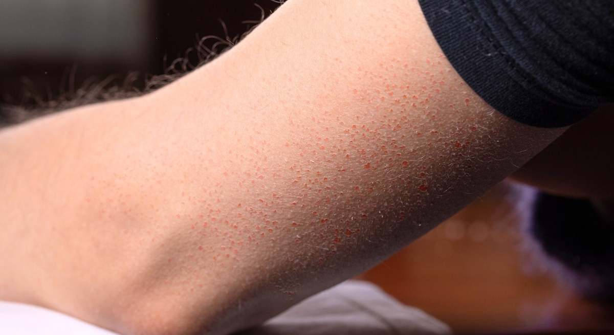 Adiós a los granitos que salen en brazos y espalda: el truco de los dermatólogos para eliminar la piel de gallina