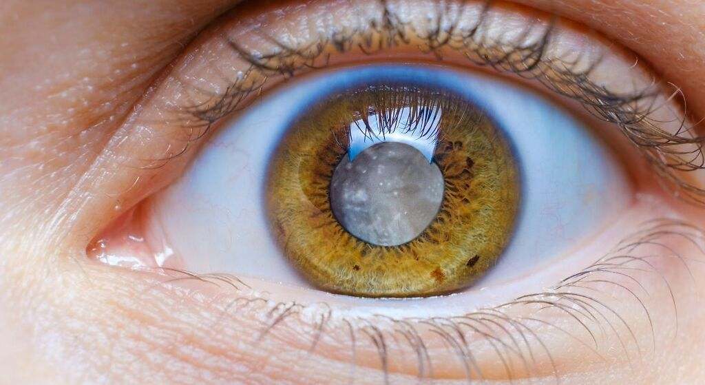 Qué es el glaucoma