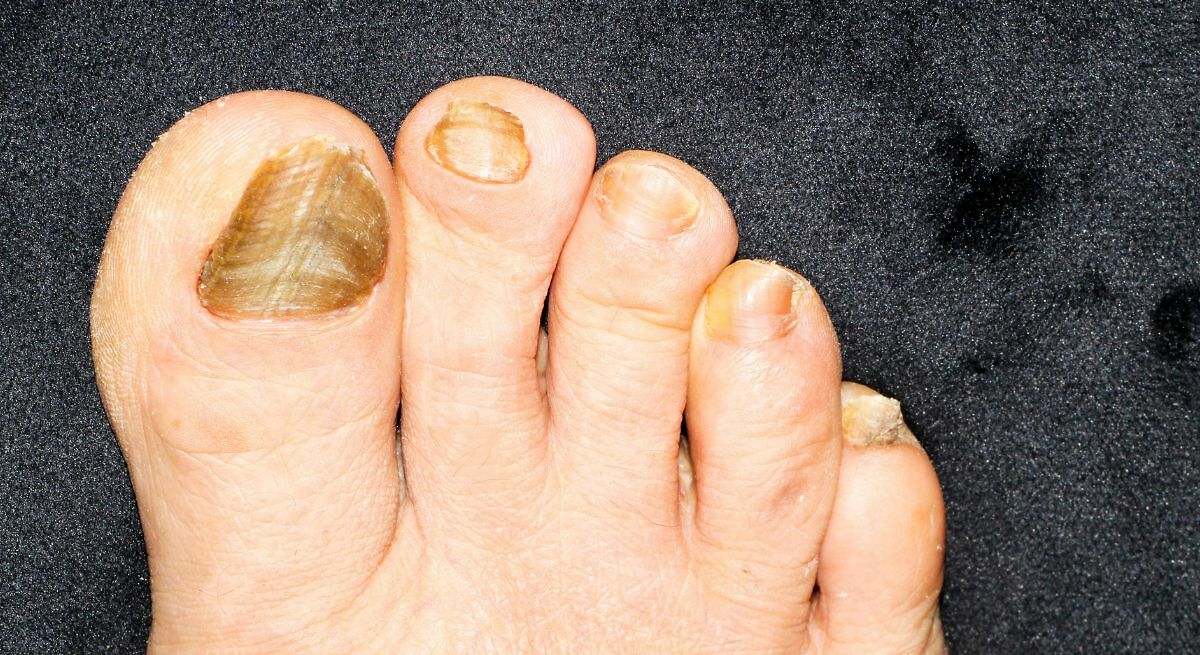 El remedio casero para eliminar todos los hongos de las uñas de forma definitiva