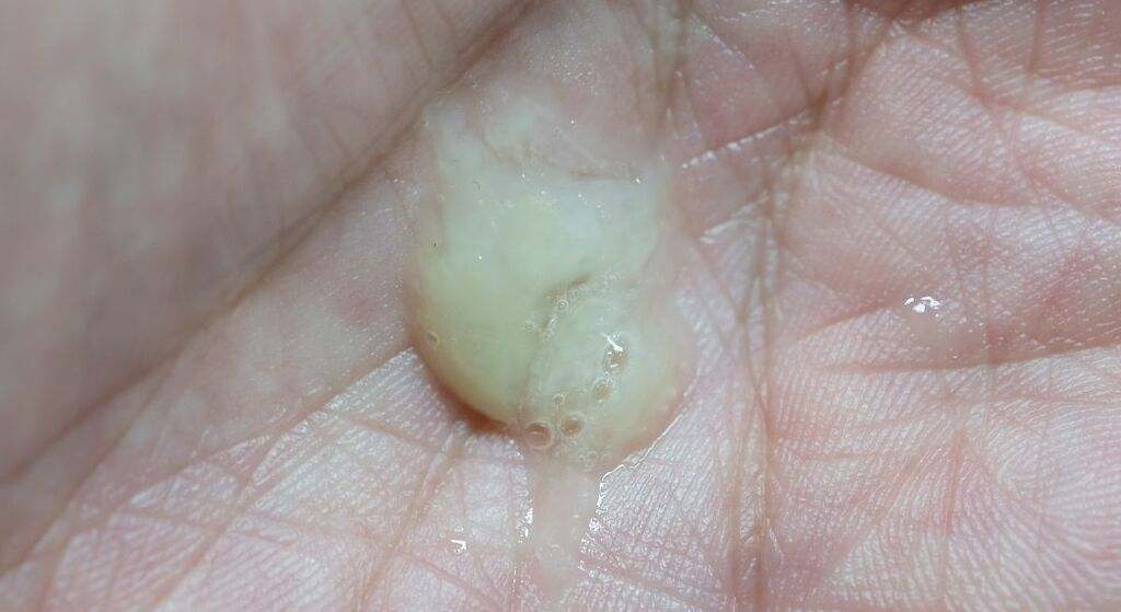 Drenaje de mucosidad desde los pulmones