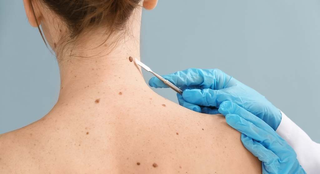 El peligro del melanoma