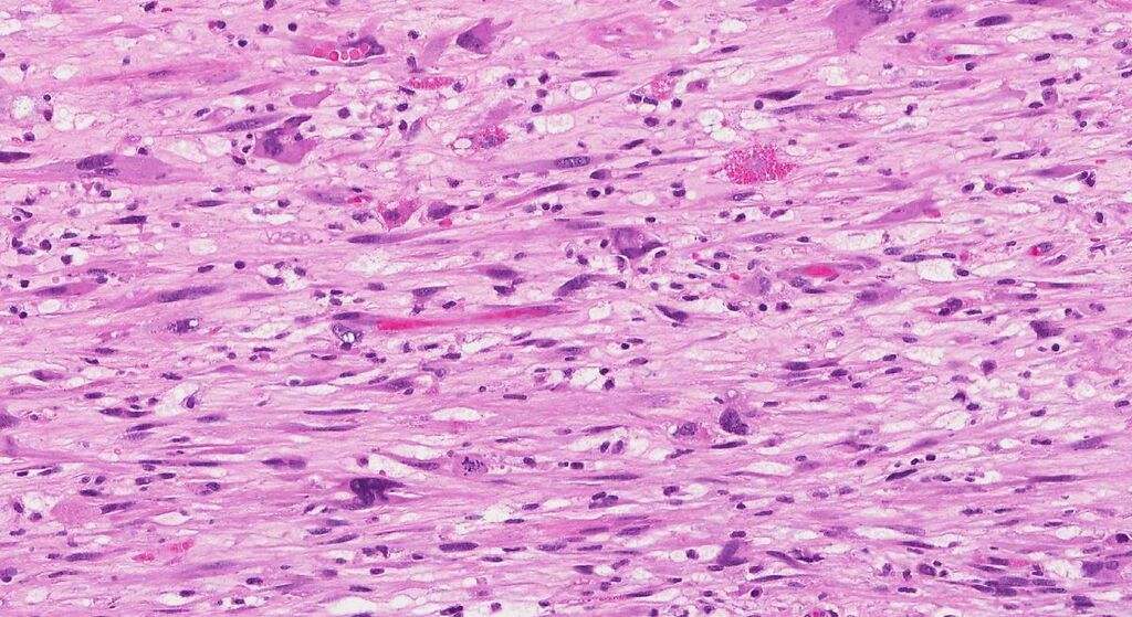 Aumento de la incidencia de neoplasias malignas