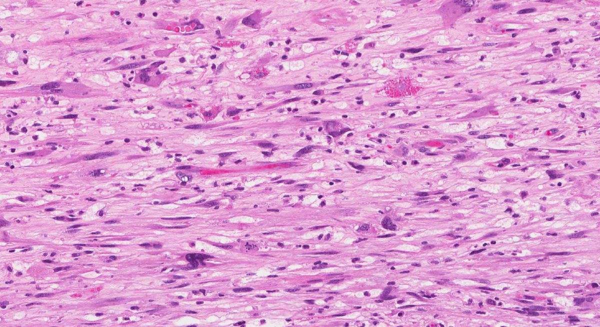 Aumento de la incidencia de neoplasias malignas