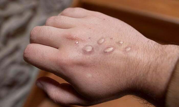 viruela-del-mono-monkeypox-istock.jpg