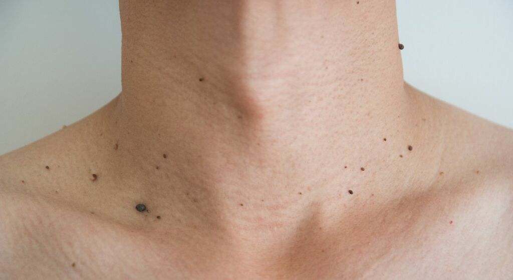 Por qué salen verrugas en el cuello y en las axilas: estos son todos los remedios caseros para quitarlas