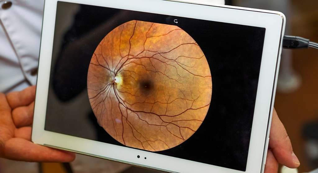 Qué es el glaucoma