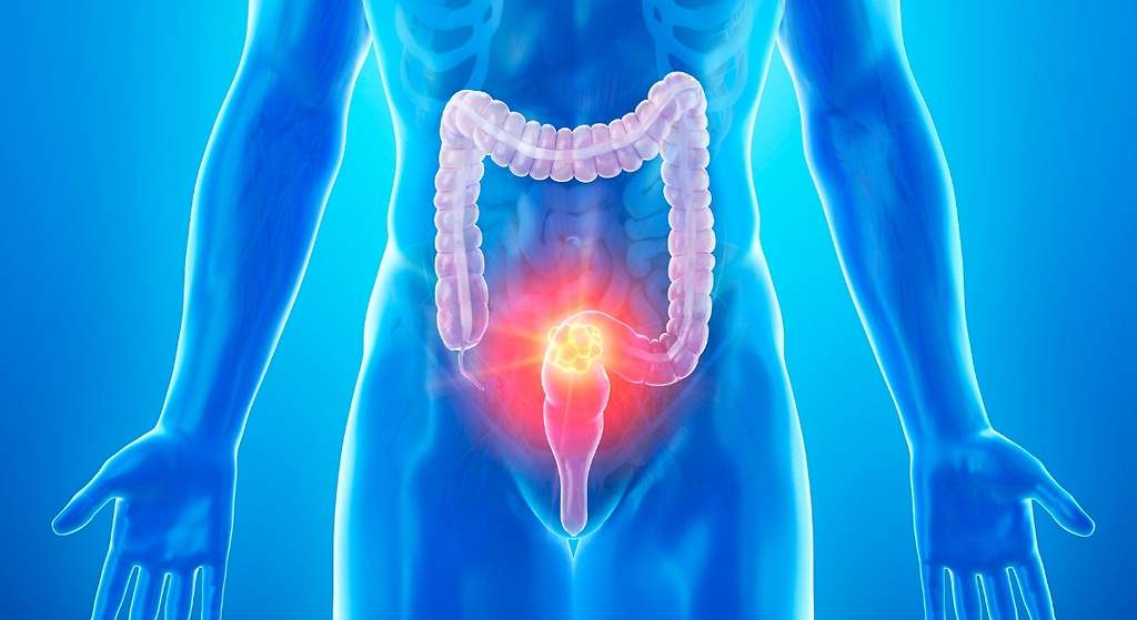 Confirmado: un estudio demuestra la posibilidad de curar el cáncer de recto sin necesidad de extirpar el órgano