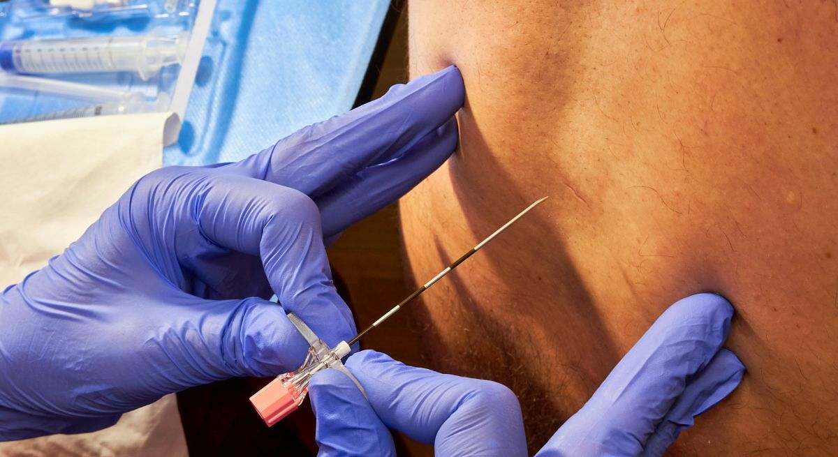 Epidural