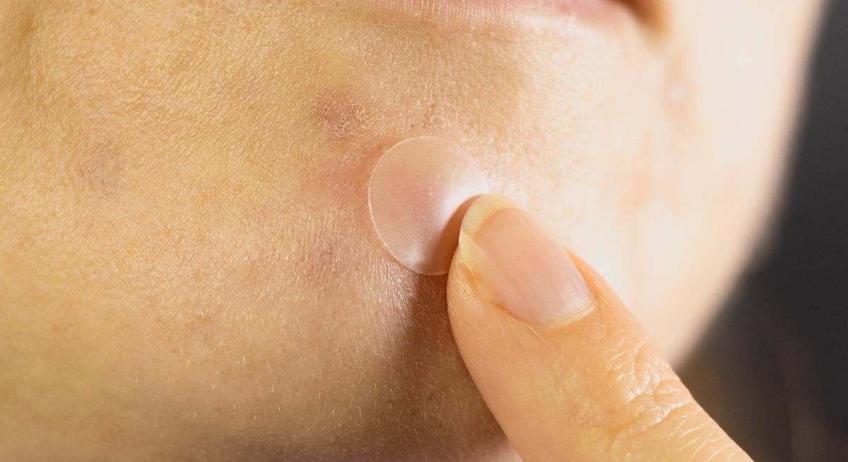 Apósitos hidrocoloides