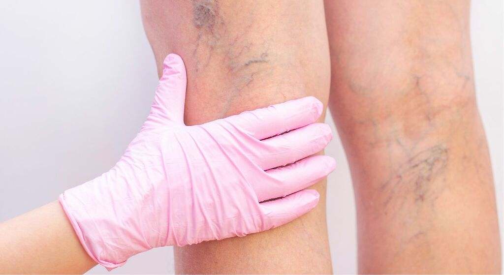 La vitamina que contribuye a mejorar la circulación de la sangre y evitar las varices