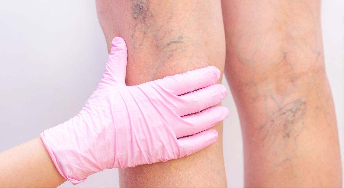 La vitamina que contribuye a mejorar la circulación de la sangre y evitar las varices