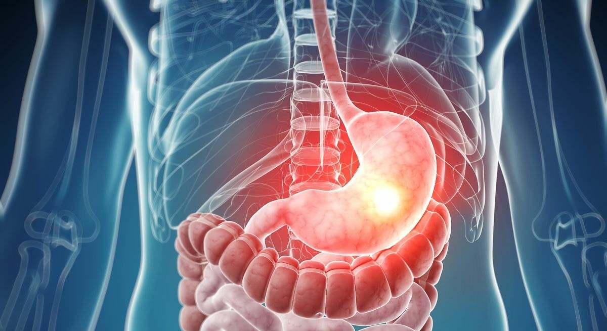 Cáncer de estómago: los 5 alimentos que pueden ayudar a prevenir esta enfermedad mortal