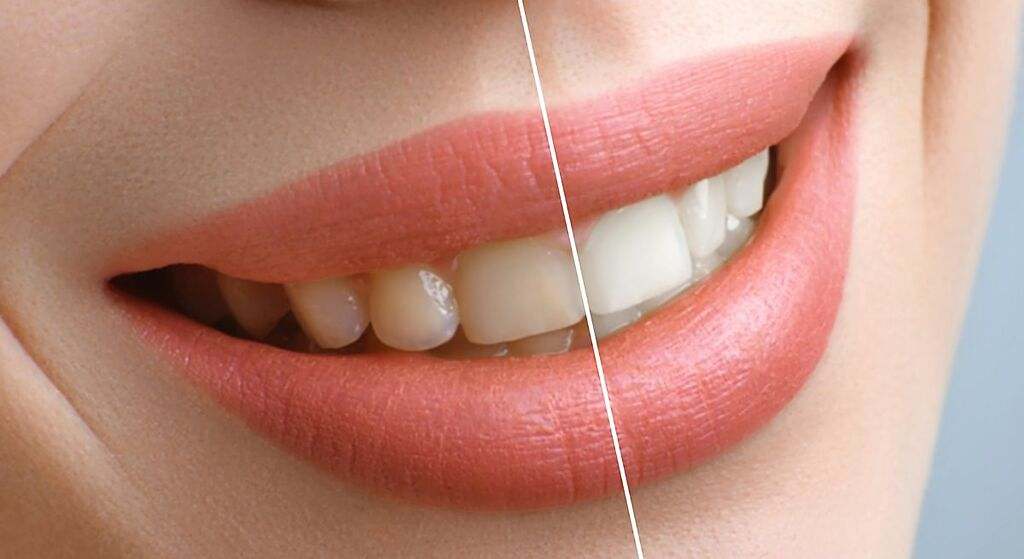 Esta es la forma correcta de blanquear los dientes, según un dentista