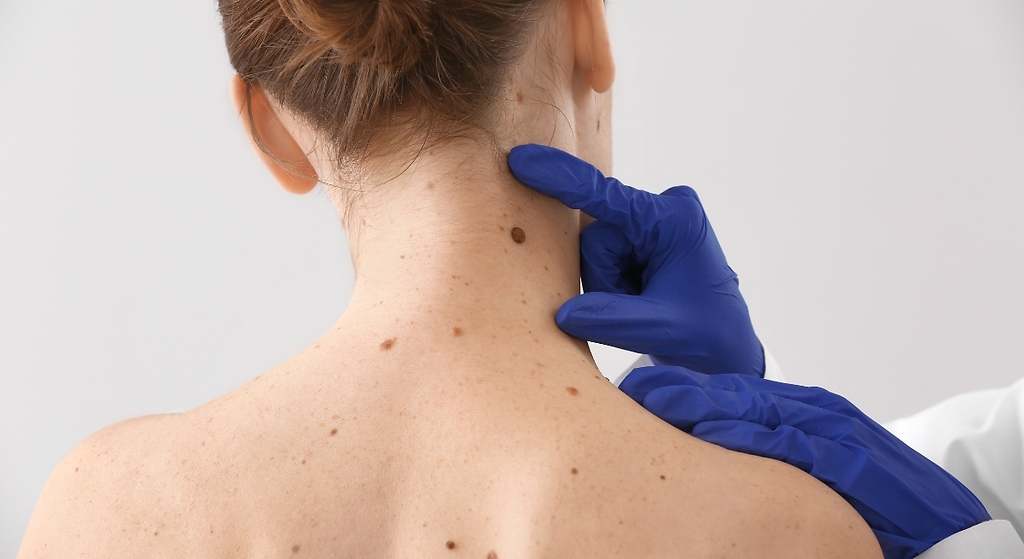 Incremento de los melanomas