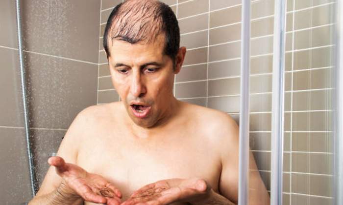 alopecia.jpg