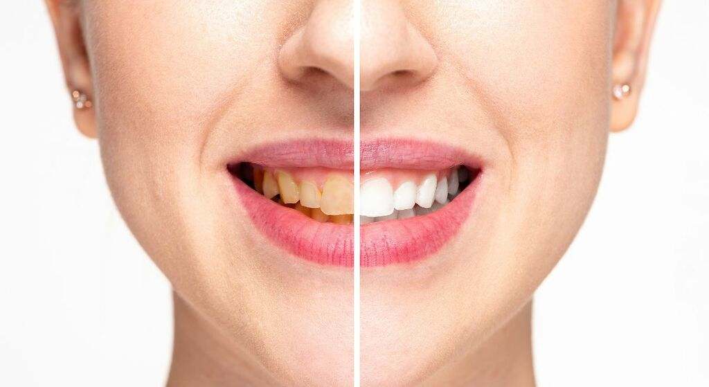 La bebida que ayuda a eliminar el sarro de los dientes de una forma rápida