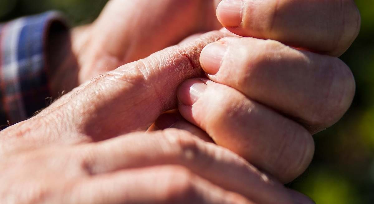 Bultos en los dedos que pican: por qué aparecen y cómo se eliminan estos molestos granitos