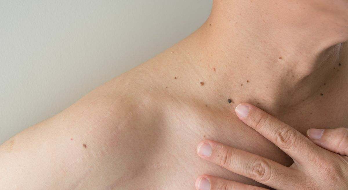 Por qué salen verrugas en el cuello y en las axilas: estos son todos los remedios caseros para quitarlas