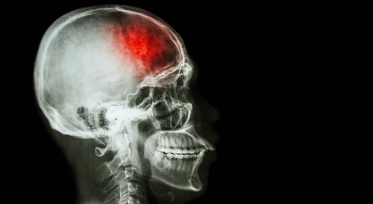 Las señales que da tu cuerpo un mes antes de sufrir un accidente cerebrovascular