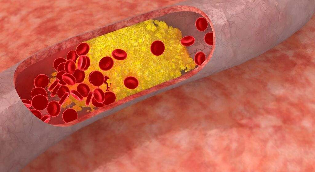 Cómo bajar el colesterol alto de forma natural y sin medicación