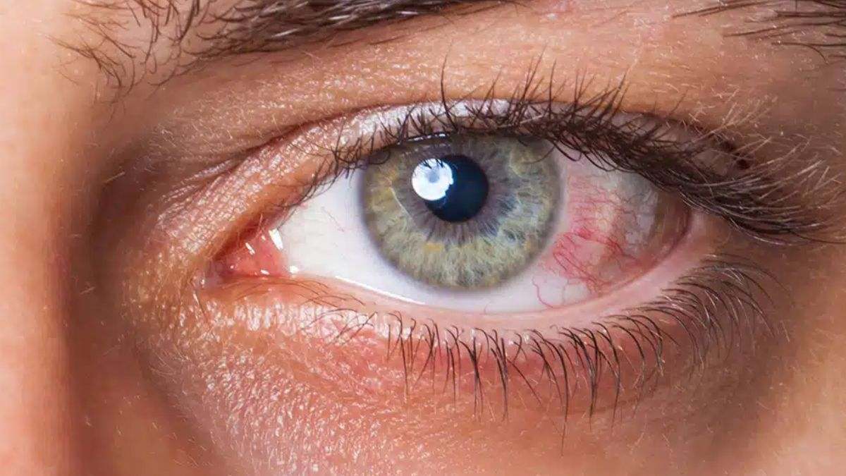 Reduce el riesgo de glaucoma