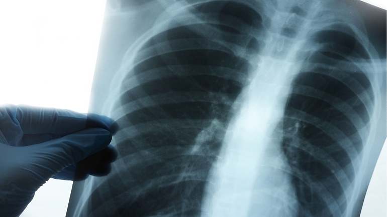 Radiografía de pulmones
