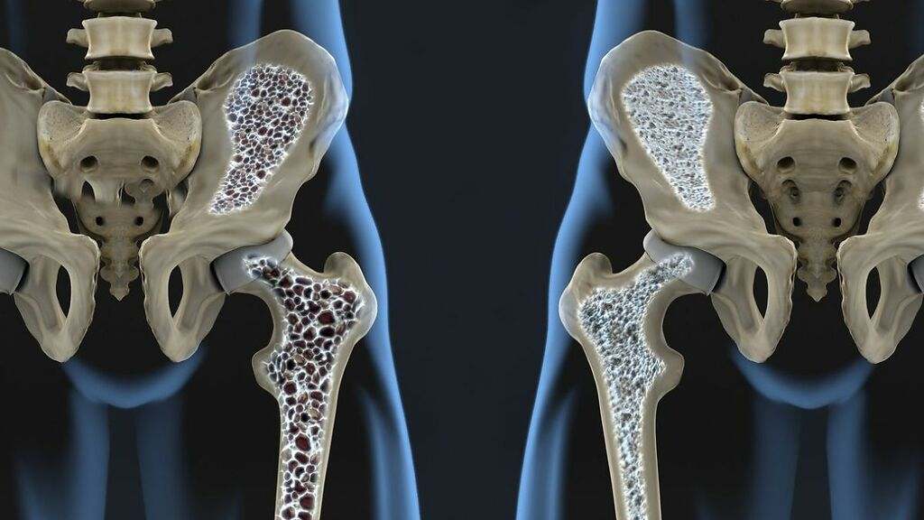 Evitar la osteoporosis