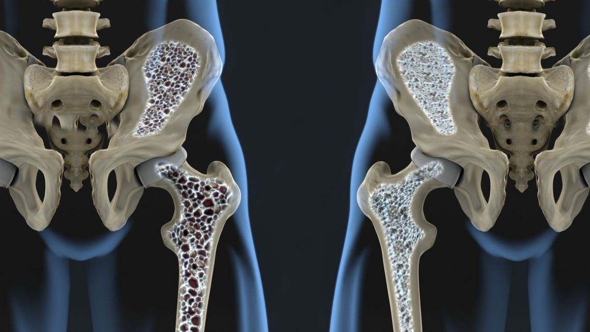 Evitar la osteoporosis