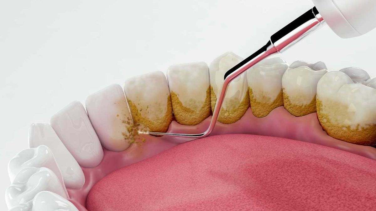 El remedio casero que ayuda a eliminar el sarro de todos los dientes de una manera rápida, según dentistas