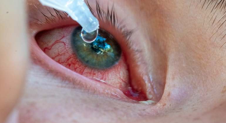Colirio en el ojo por conjuntivitis