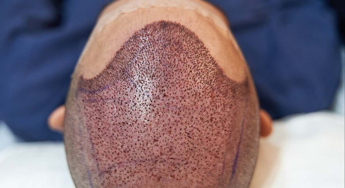 La vacuna que promete curar la alopecia pone en alerta a la industria del trasplante capilar