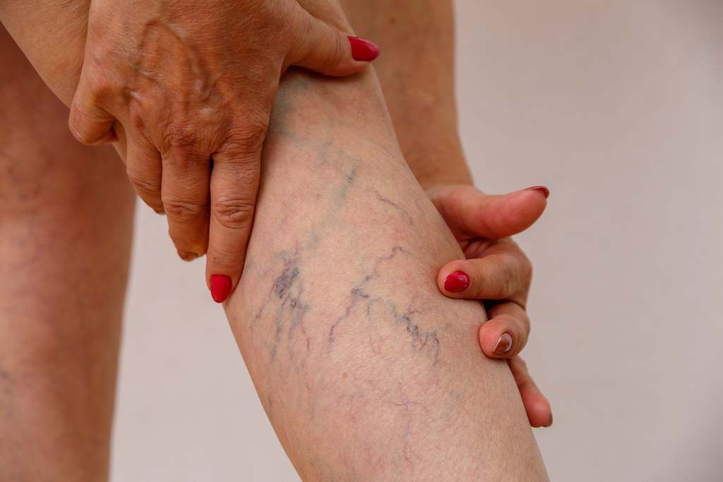 ¿Por qué me salen varices?