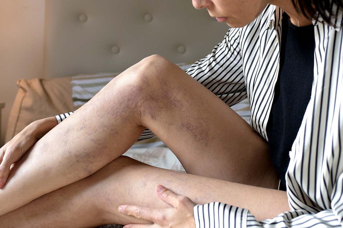 El remedio casero para suavizar las varices y reducir la inflamación en las piernas de forma natural