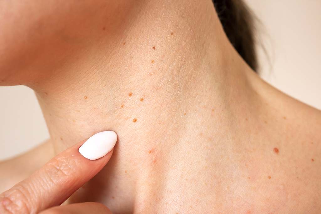 Por qué salen verrugas en el cuello y en las axilas: estos son todos los remedios caseros para quitarlas