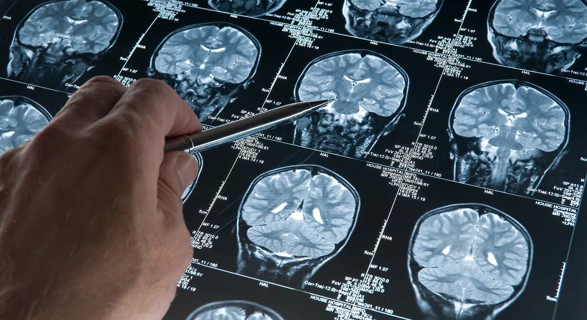 Las personas con nivel educativo medio-alto, diagnosticadas con Alzheimer más tarde: "Se pueden pasar por alto los primeros signos"