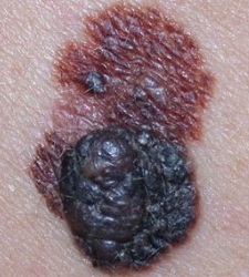 melanoma-bellvitge.jpg
