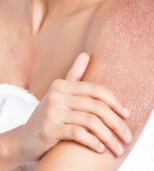 psoriasis-efe.jpg